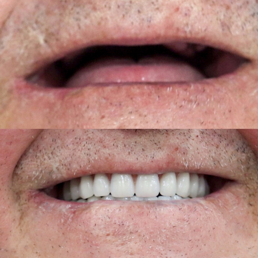 Antes e Depois