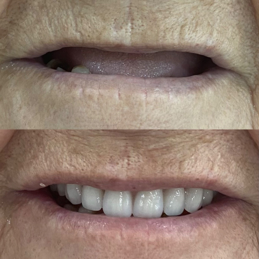 Antes e depois 1