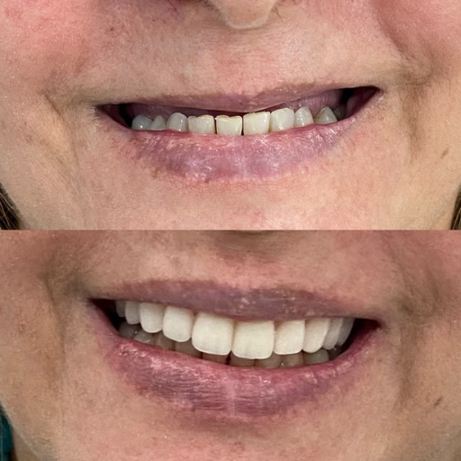 Antes e depois 2