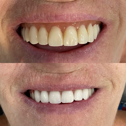 Antes e depois 3